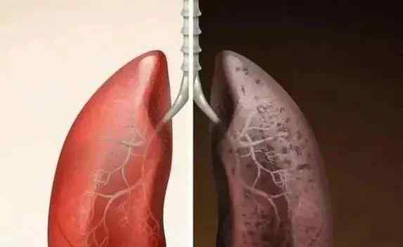抽烟肺部隐隐作痛 长期抽烟的人 身上若没有“2处凸起 3处疼痛” 说明肺还算健康